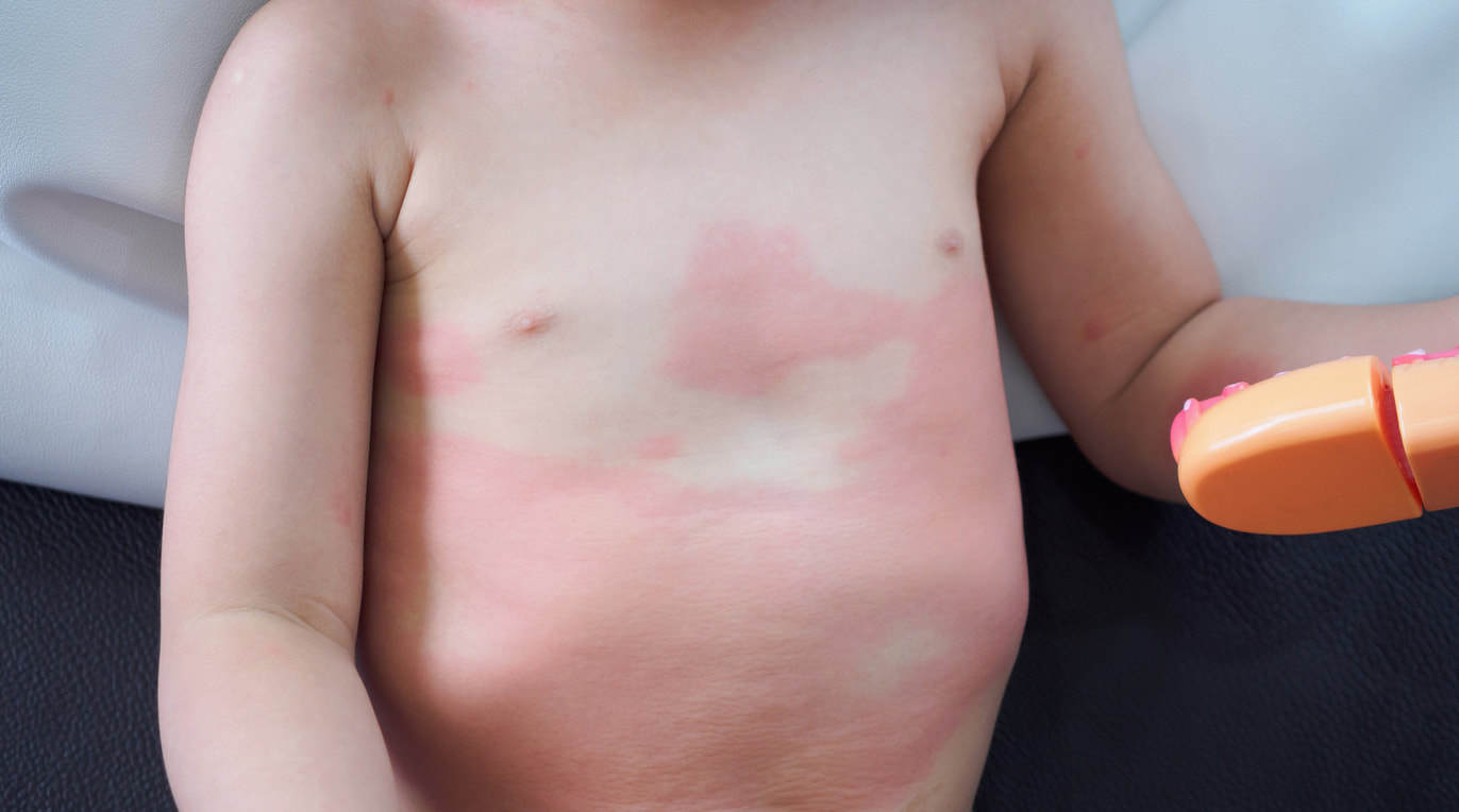 Suppressed eczema returning during homeopathic care
