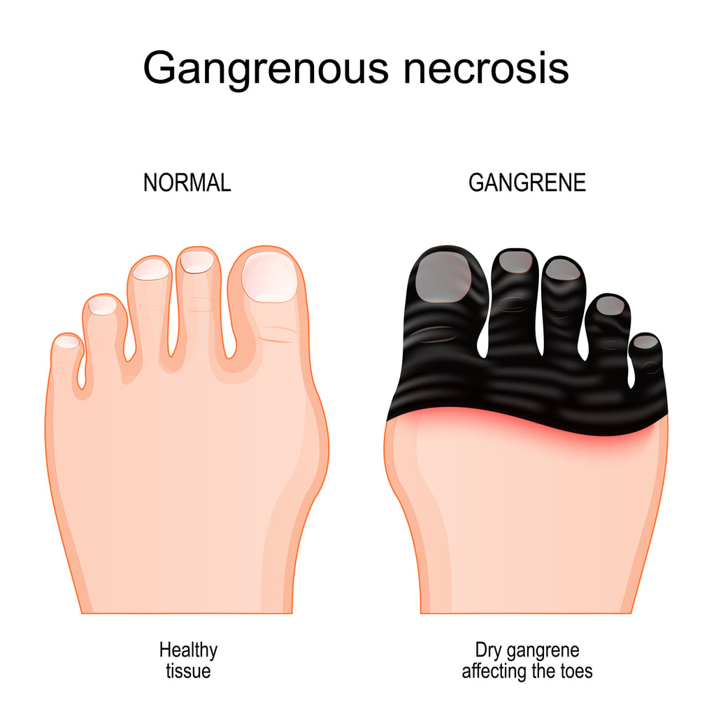 Homeopathy and diabetic foot ulcers, gangrene